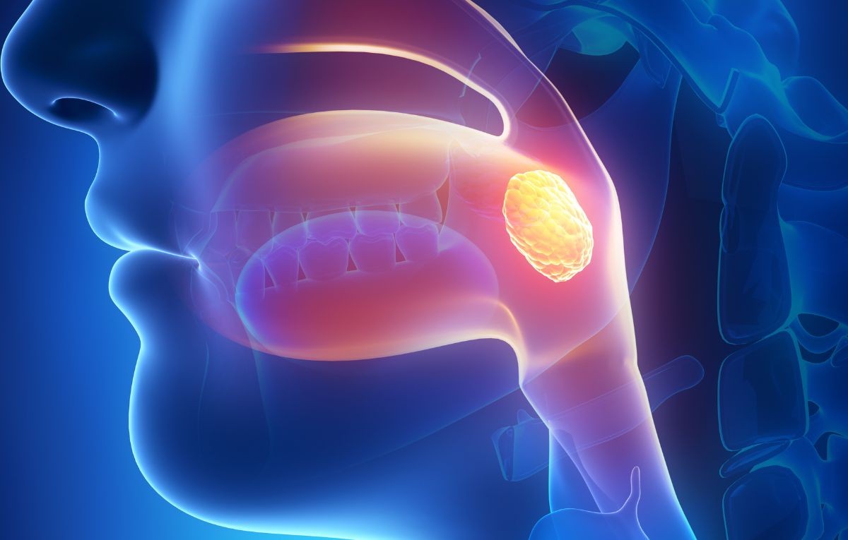 Amigdalectomia e Adenoidectomia